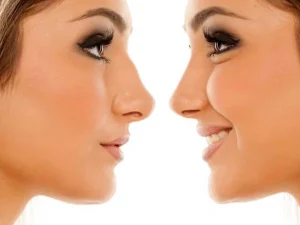 عمل بینی طبیعی