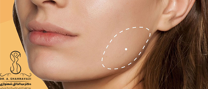 جراحی بوکال فت چیست؟