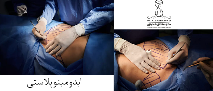درباره ابدومینوپلاستی