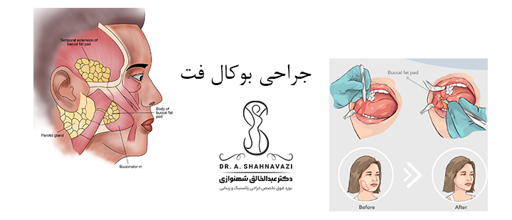 درباره جراحی بوکال فت