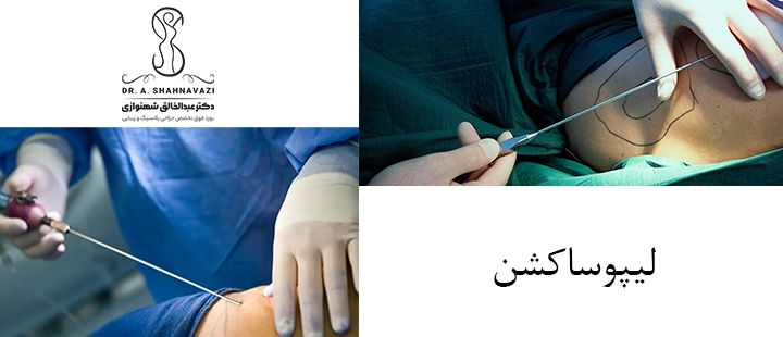 درباره لیپوساکشن