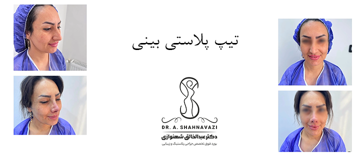 تیپ پلاستی بینی چیست؟