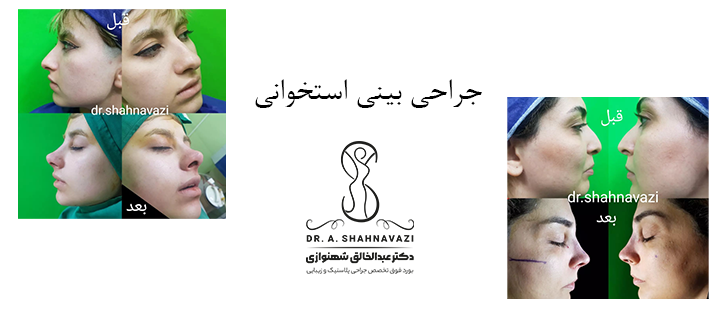 درباره جراحی بینی استخوانی 