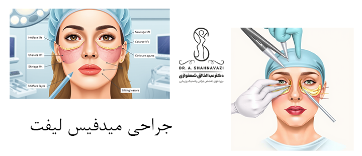 درباره جراحی میدفیس لیفت
