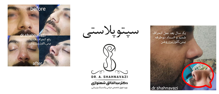 درباره سپتوپلاستی 