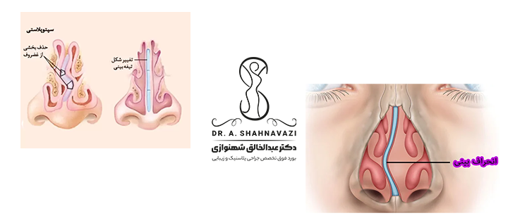 سپتوپلاستی چیست؟