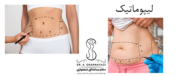 لیپوماتیک چیست؟