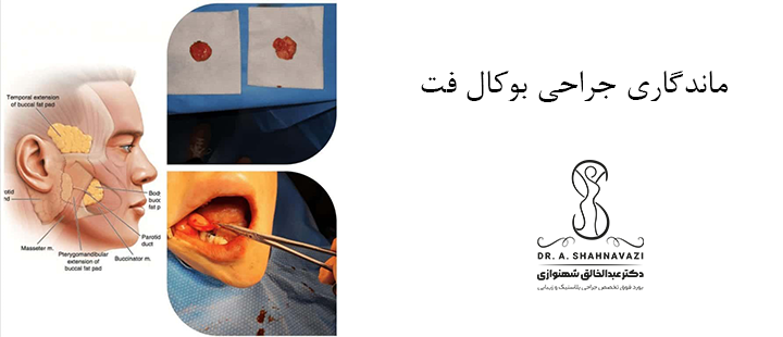 ماندگاری جراحی بوکال فت 