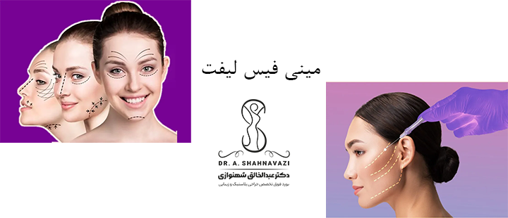 مینی فیس لیفت چیست؟