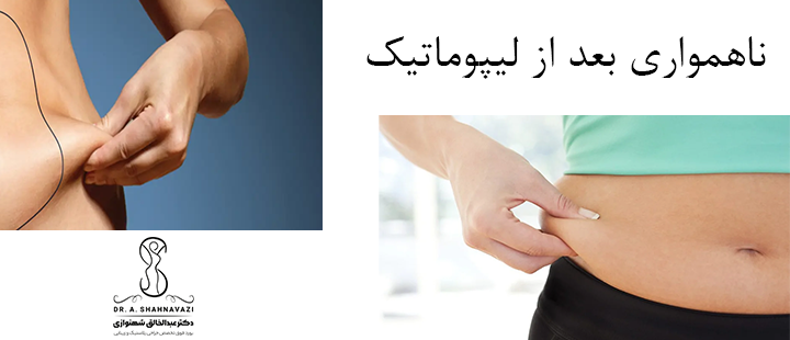 درباره ناهمواری بعد از لیپوماتیک