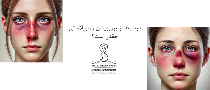 درد بعد از پرزرویشن رینوپلاستی چقدر است؟