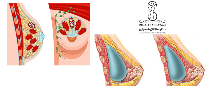 علائم ورم سینه بعد از ماموپلاستی 