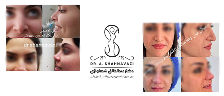 نمونه کار جراحی بینی ترمیمی 