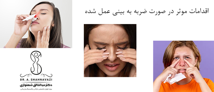 اقدامات موثر در صورت ضربه به بینی عمل شده