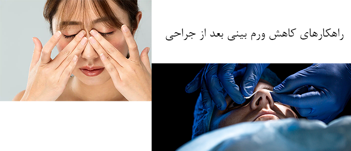 راهکارهای کاهش ورم بینی بعد از عمل 