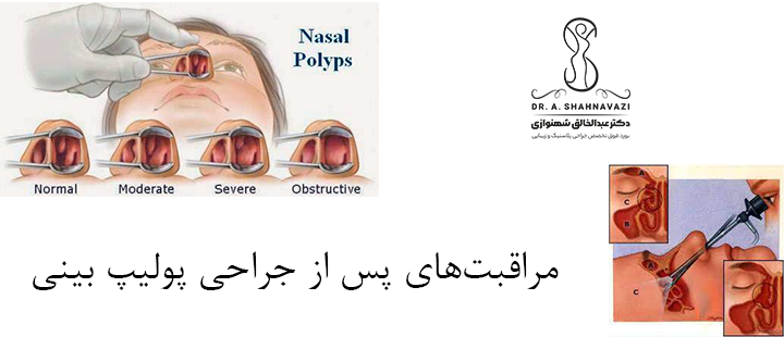 مراقبت‌های پس از جراحی پولیپ بینی