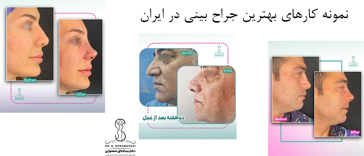 نمونه کارهای بهترین جراح بینی در ایران