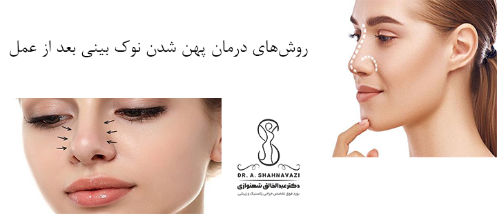 روش‌های درمان پهن شدن نوک بینی بعد از عمل
