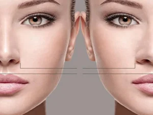 پهن شدن نوک بینی بعد از عمل